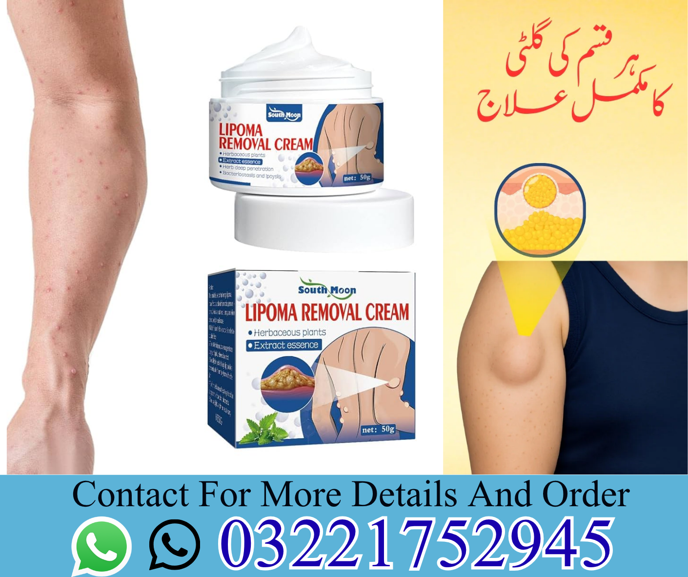 Lipoma Removal Cream Available In Pakistan Lahore Islamabad